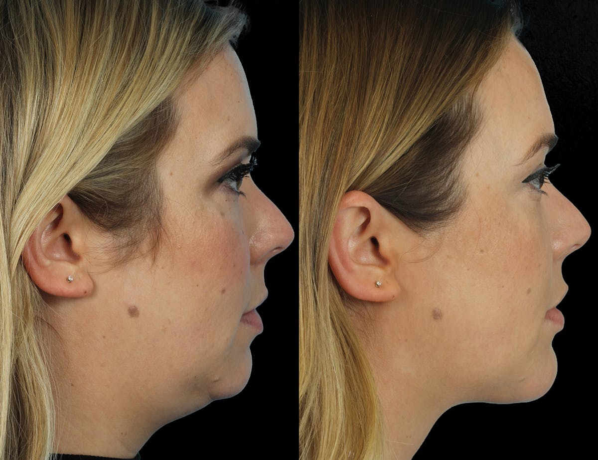 Aging Face Before & After Gallery - Patient 311497 - Image 2