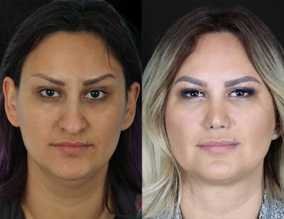 Aging Face Before & After Gallery - Patient 222009 - Image 1