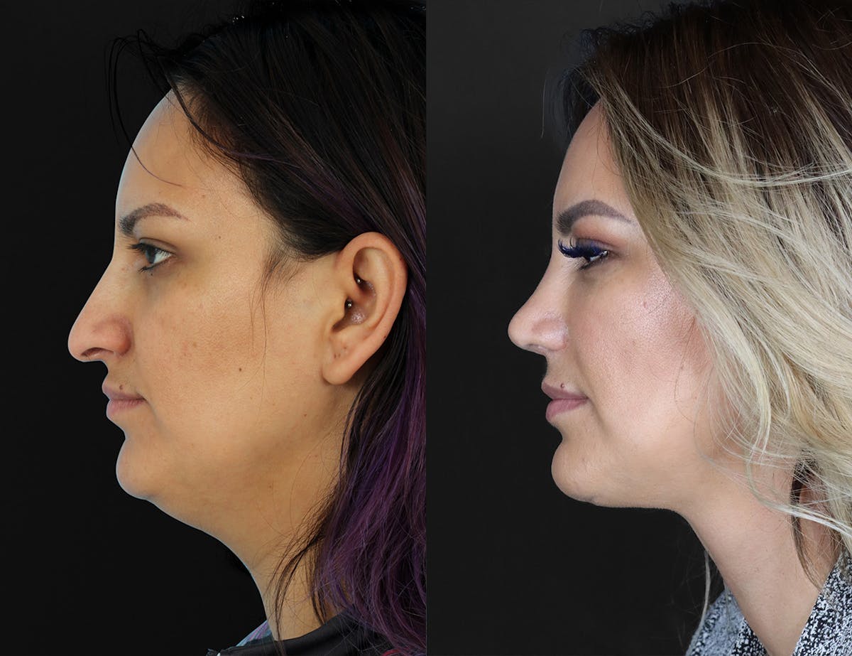 Aging Face Before & After Gallery - Patient 222009 - Image 3