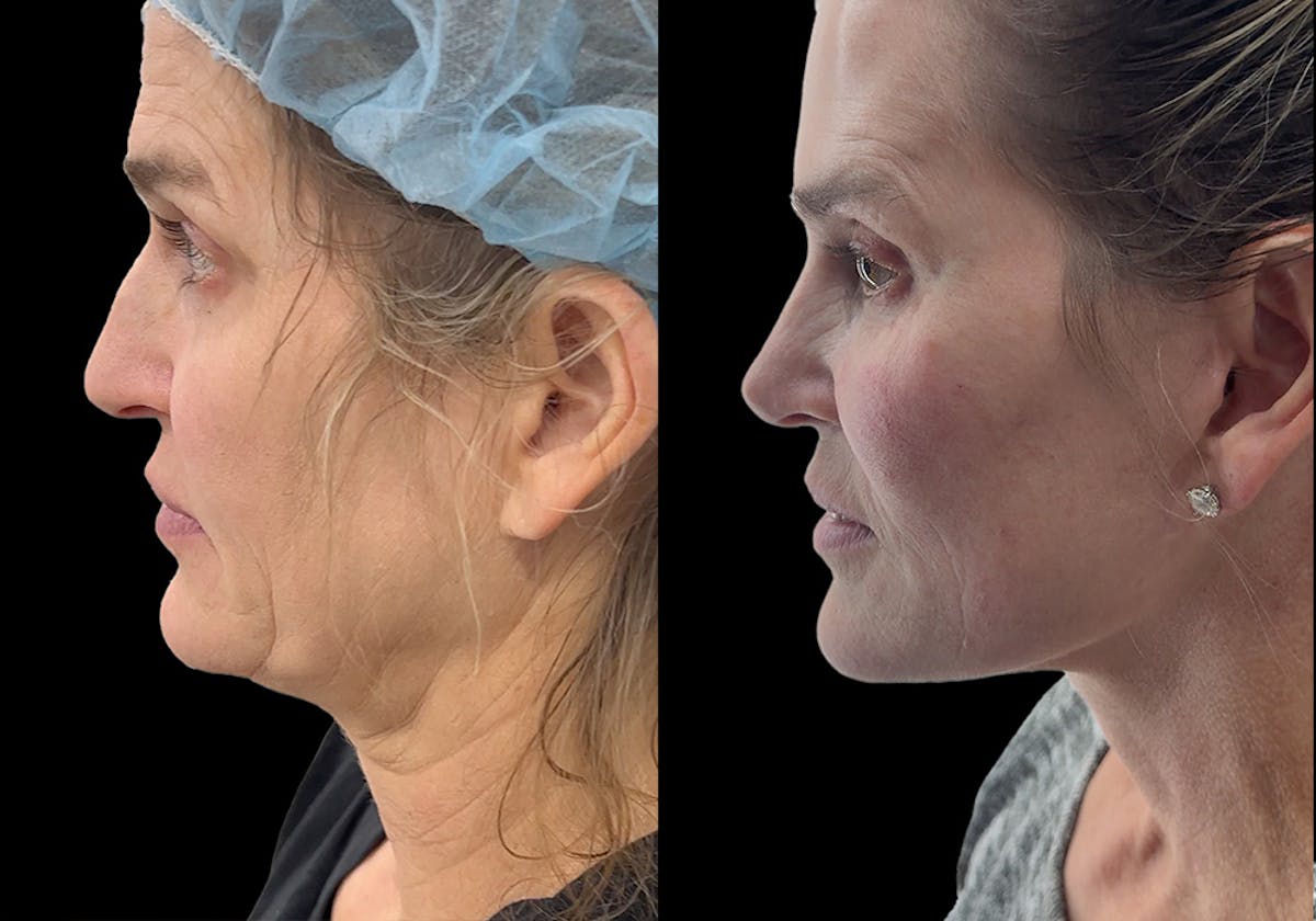 Aging Face Before & After Gallery - Patient 275775 - Image 3