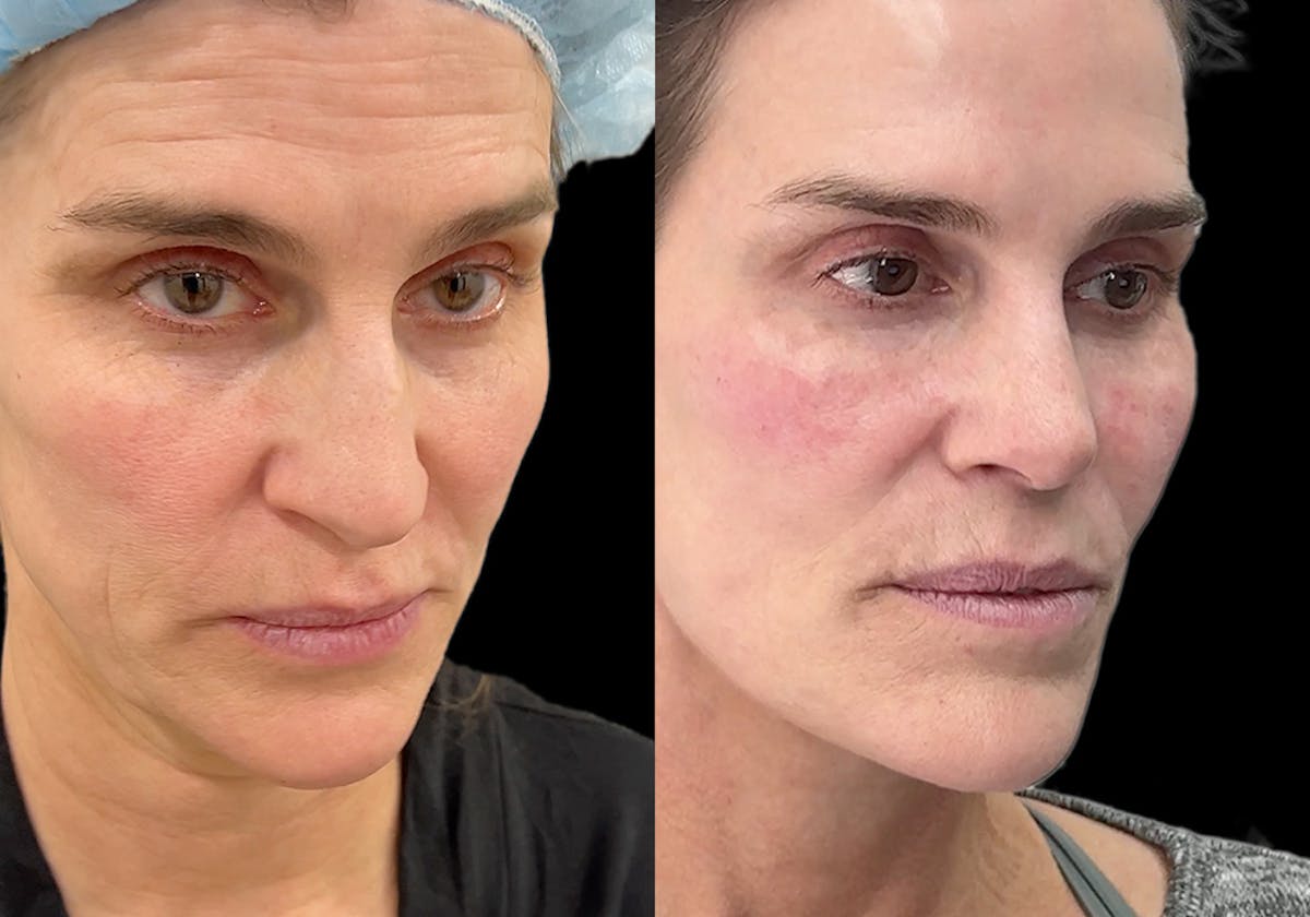 Aging Face Before & After Gallery - Patient 275775 - Image 2