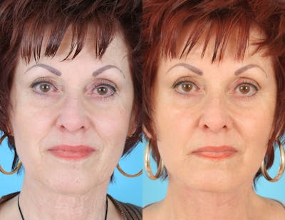 Aging Face Before & After Gallery - Patient 324056 - Image 1