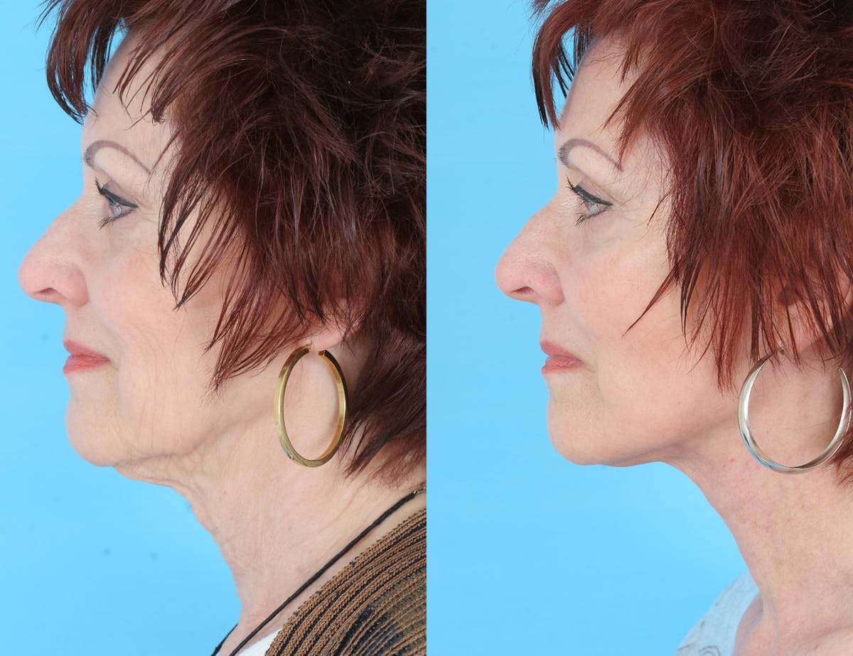 Aging Face Before & After Gallery - Patient 324056 - Image 2