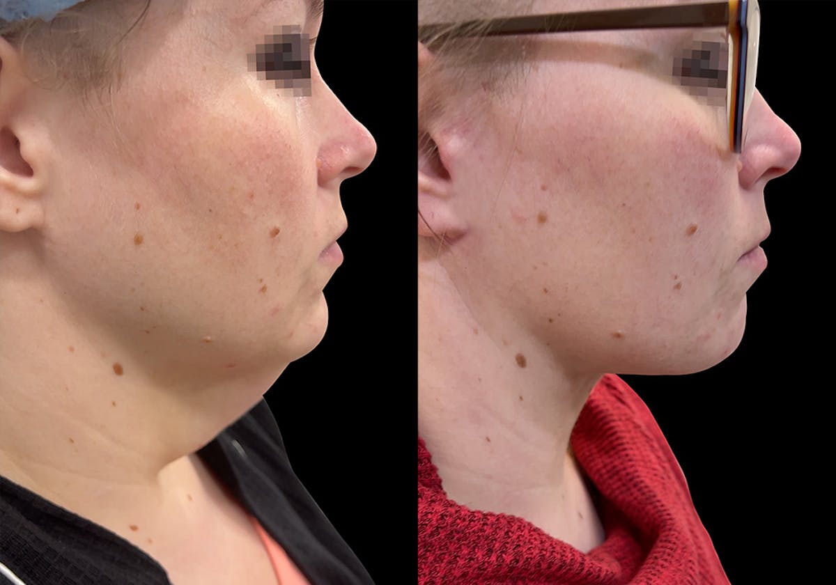 Aging Face Before & After Gallery - Patient 173537 - Image 1
