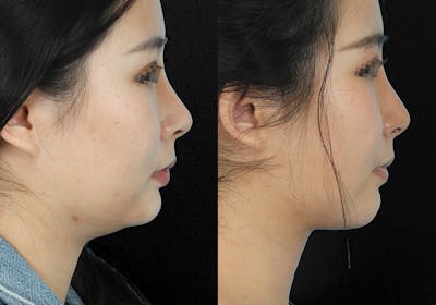 Aging Face Before & After Gallery - Patient 976421 - Image 1