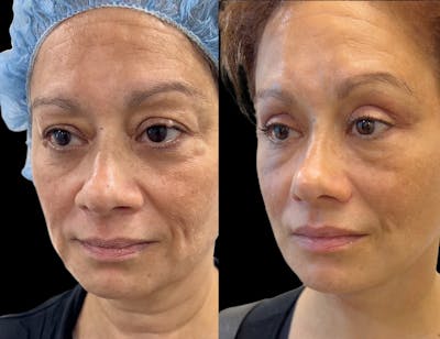 Aging Face Before & After Gallery - Patient 331178 - Image 1