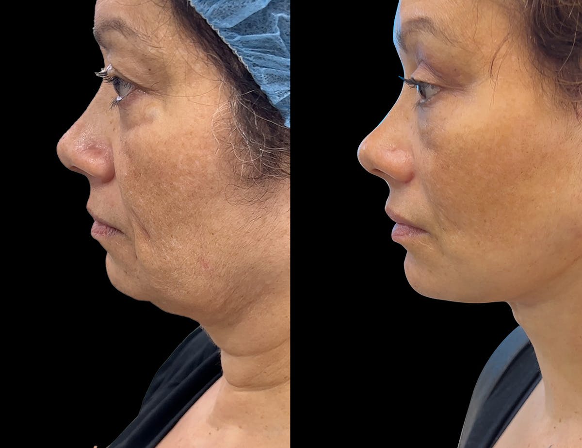 Aging Face Before & After Gallery - Patient 331178 - Image 3
