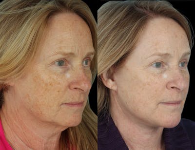 Aging Face Before & After Gallery - Patient 201098 - Image 1