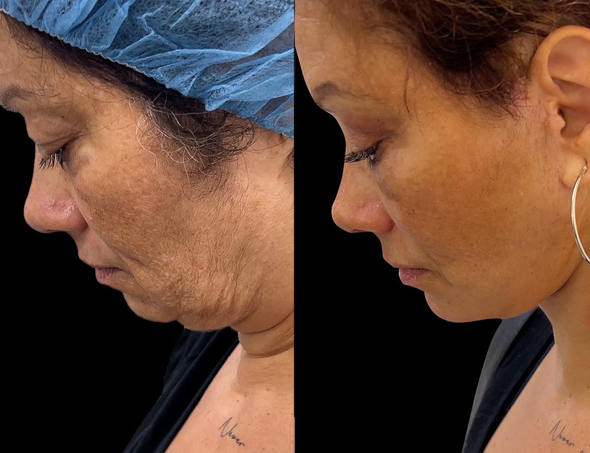Aging Face Before & After Gallery - Patient 331178 - Image 2