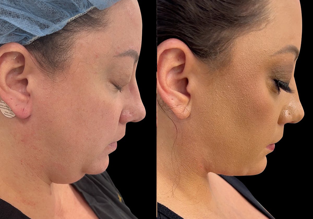 Aging Face Before & After Gallery - Patient 310289 - Image 2