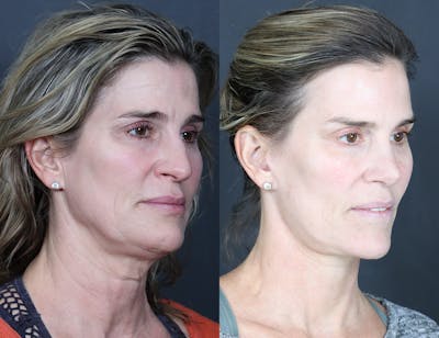 Aging Face Before & After Gallery - Patient 249323 - Image 1
