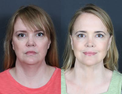 Aging Face Before & After Gallery - Patient 425174 - Image 1