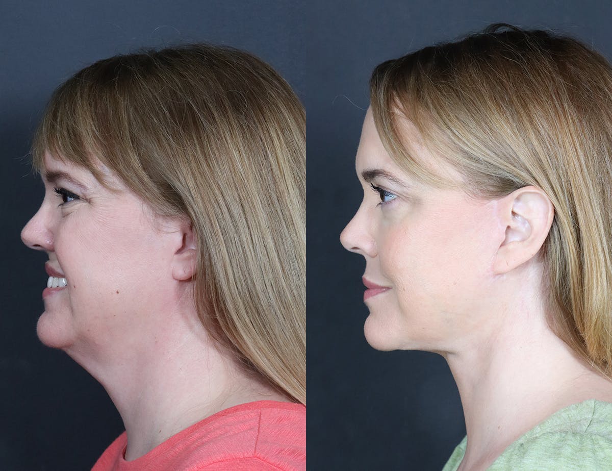 Aging Face Before & After Gallery - Patient 425174 - Image 3