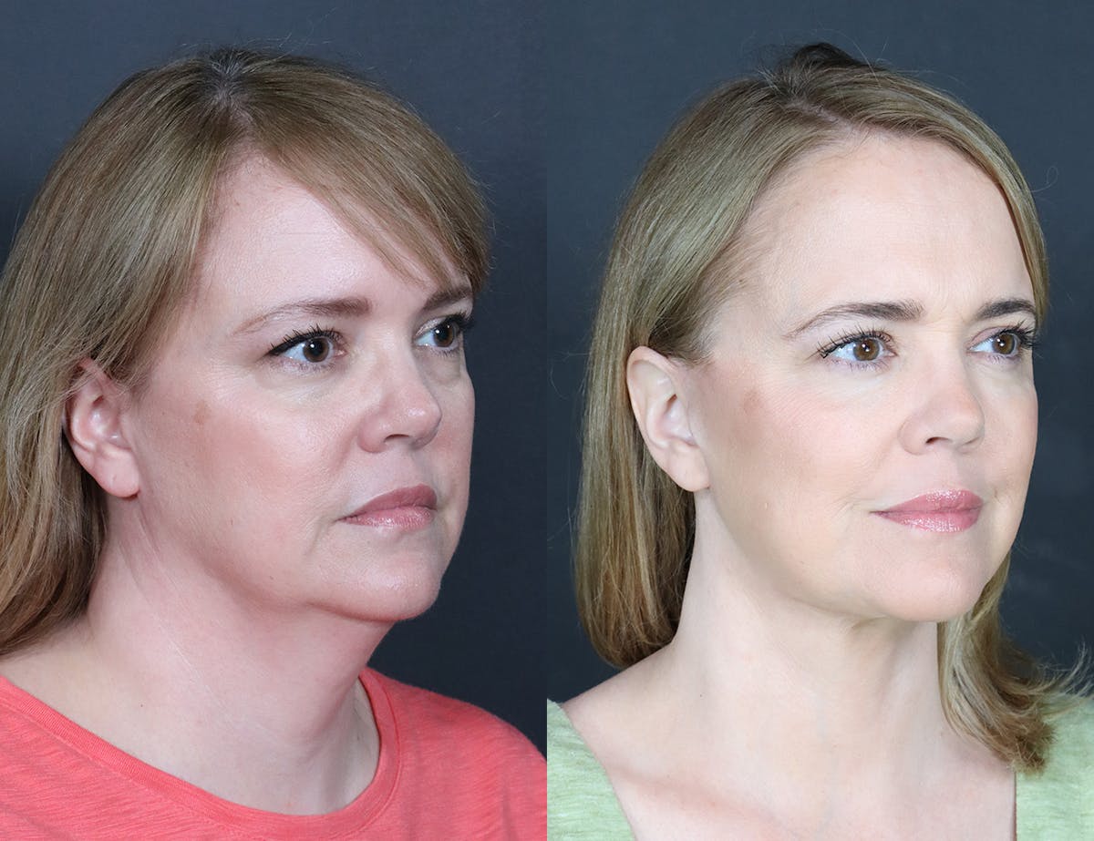 Aging Face Before & After Gallery - Patient 425174 - Image 2