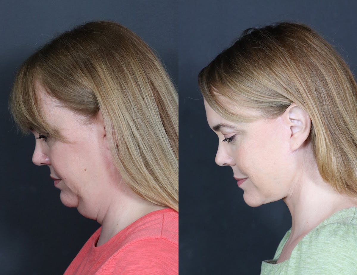Aging Face Before & After Gallery - Patient 425174 - Image 4