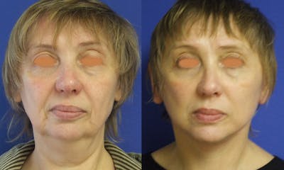 Aging Face Before & After Gallery - Patient 193184 - Image 1