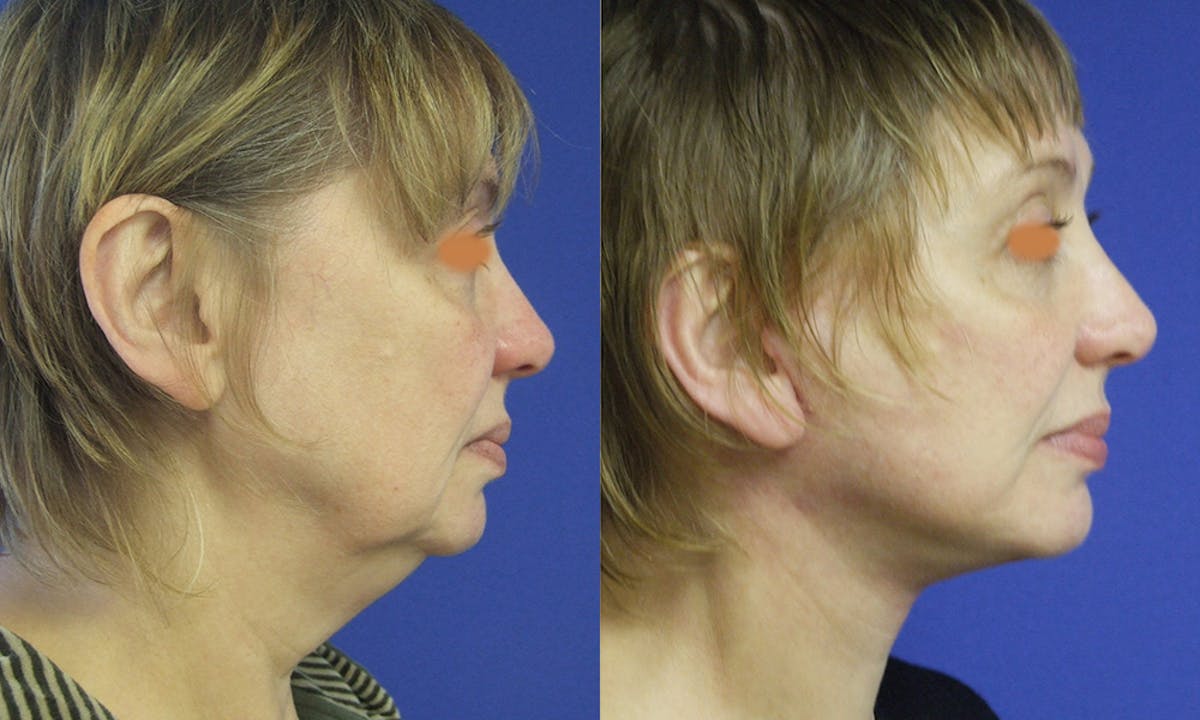 Aging Face Before & After Gallery - Patient 193184 - Image 2