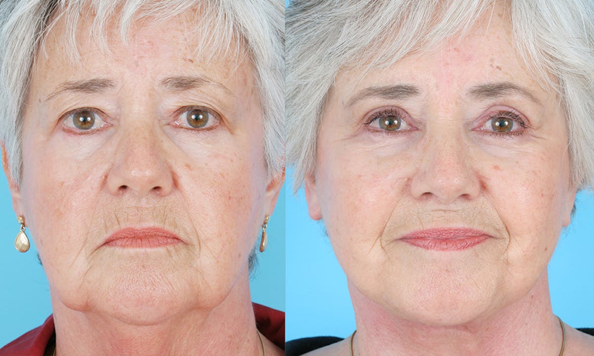 Patient 248278 Aging Face Before & After Photos Dr. Anil Shah