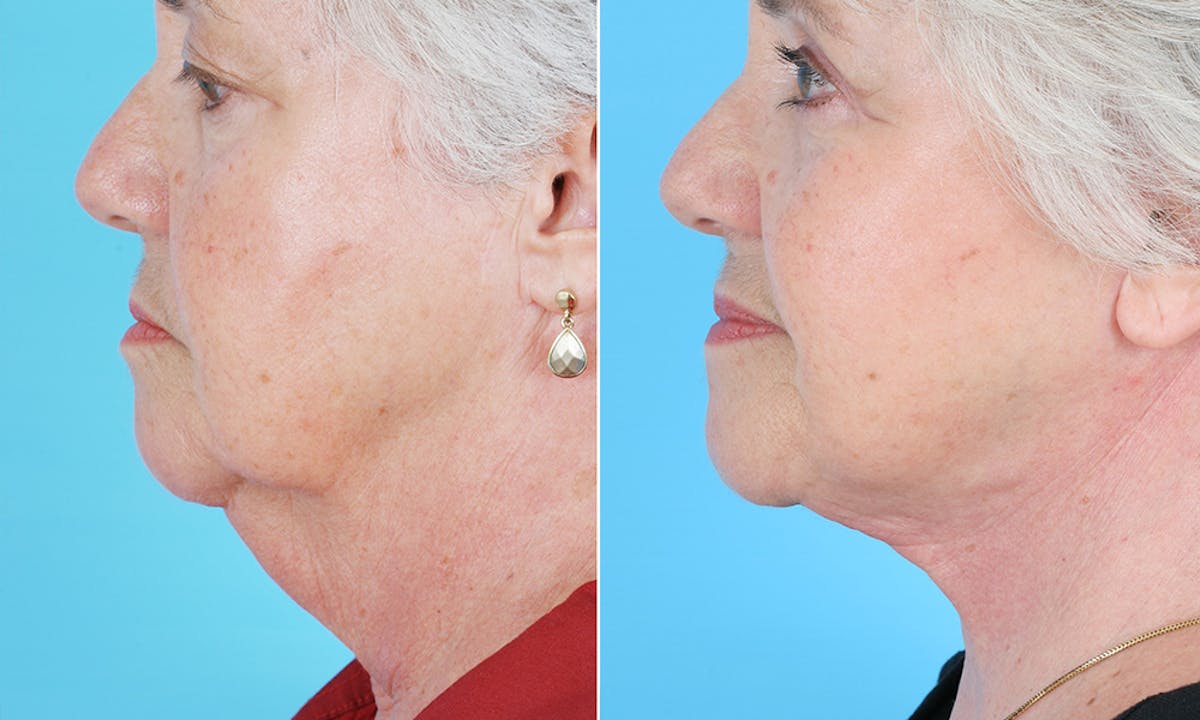 Aging Face Before & After Gallery - Patient 248278 - Image 2