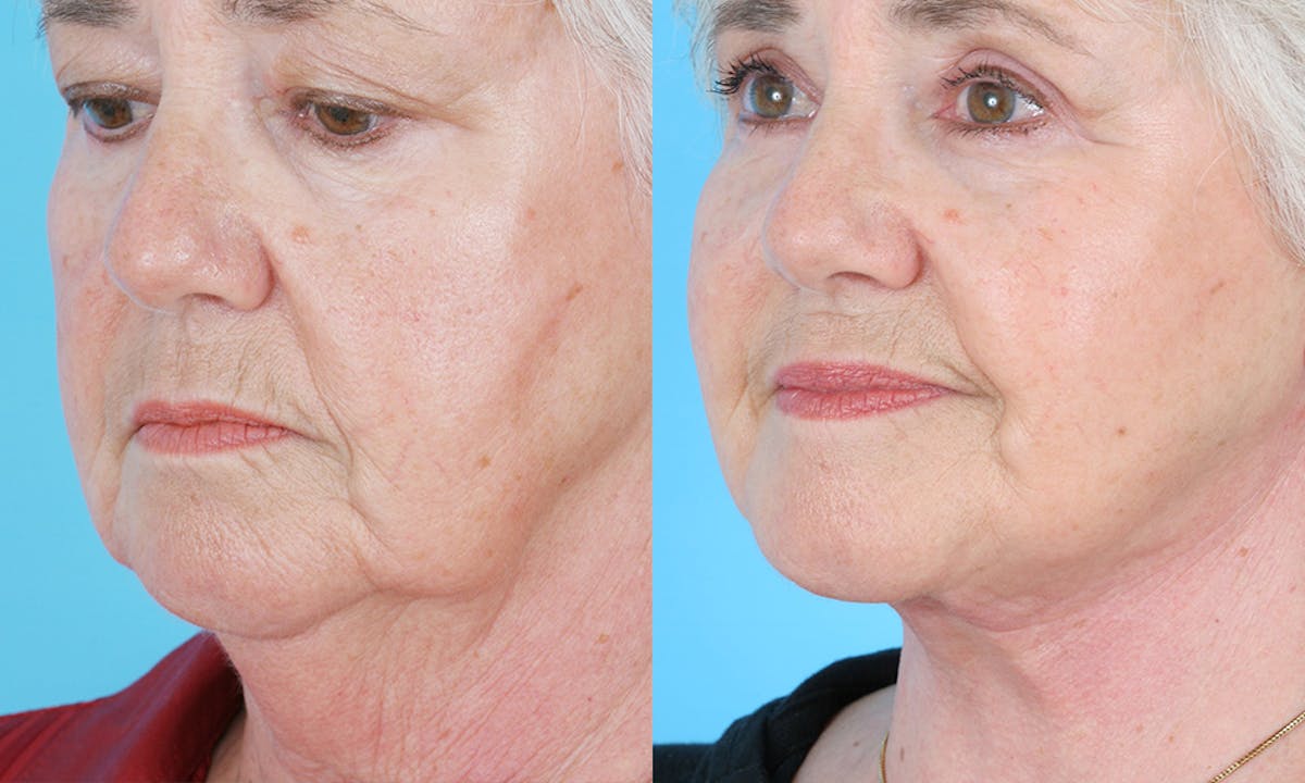 Aging Face Before & After Gallery - Patient 248278 - Image 3