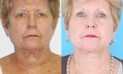 Aging Face Before & After Gallery - Patient 224078 - Image 1