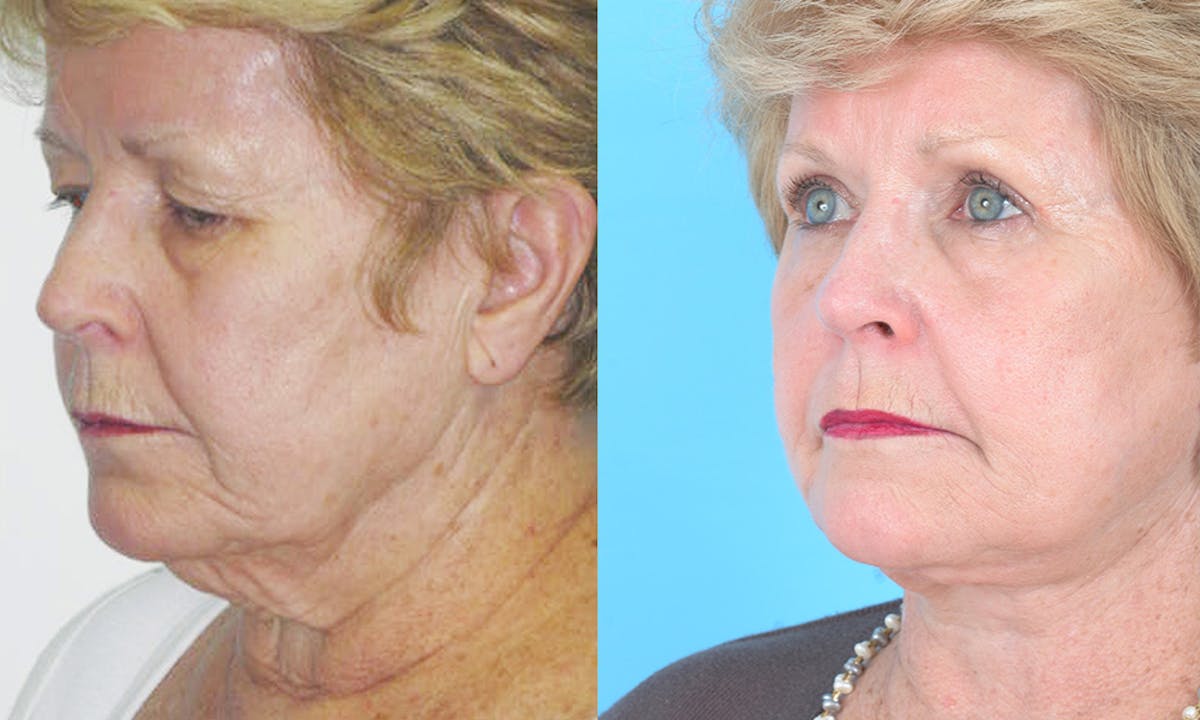Aging Face Before & After Gallery - Patient 224078 - Image 2