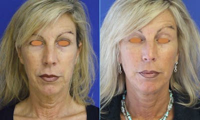 Aging Face Before & After Gallery - Patient 732630 - Image 1