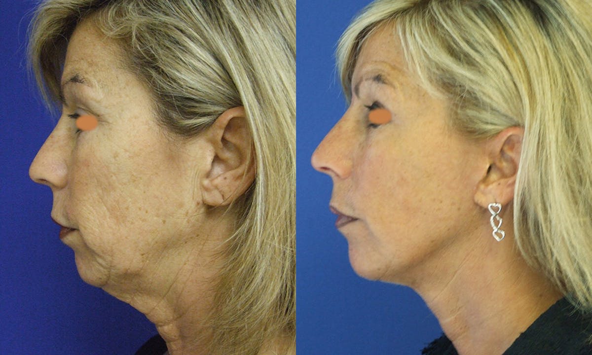 Aging Face Before & After Gallery - Patient 732630 - Image 2