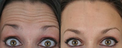 BOTOX Fillers Before & After Gallery - Patient 374409 - Image 1