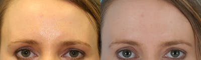 BOTOX Fillers Before & After Gallery - Patient 122705 - Image 1