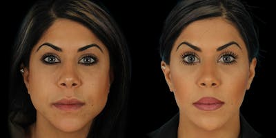 BOTOX Fillers Before & After Gallery - Patient 205251 - Image 1