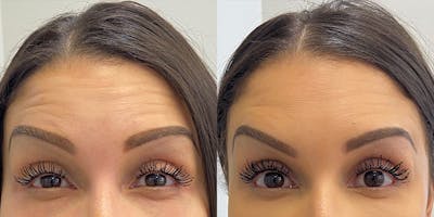 BOTOX Fillers Before & After Gallery - Patient 102926 - Image 1