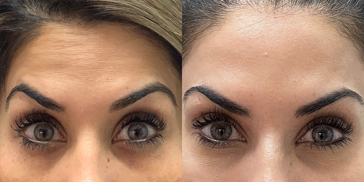 BOTOX Fillers Before & After Gallery - Patient 102926 - Image 3