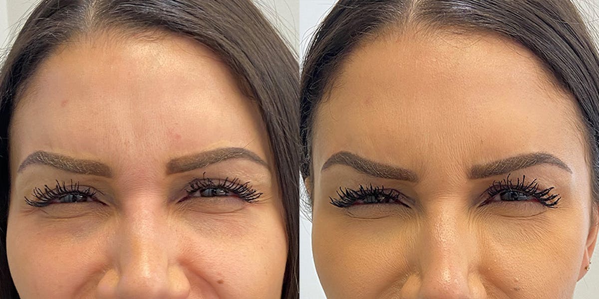 BOTOX Fillers Before & After Gallery - Patient 102926 - Image 2