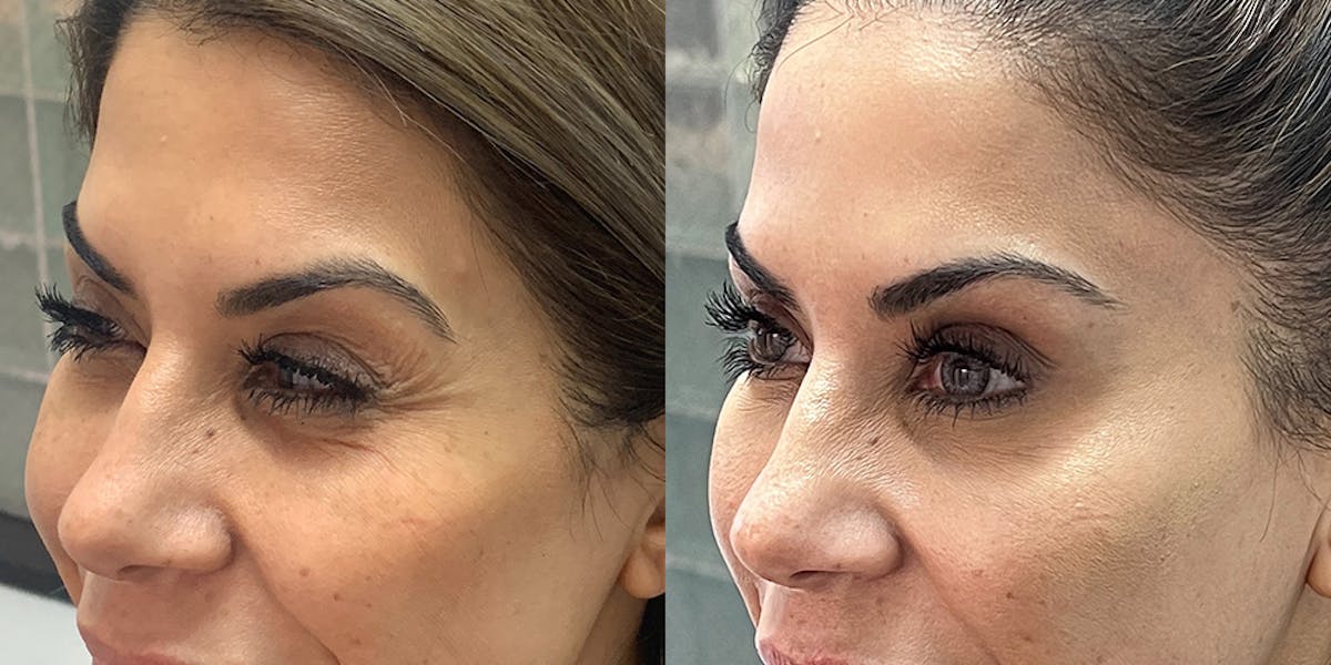 BOTOX Fillers Before & After Gallery - Patient 102926 - Image 4