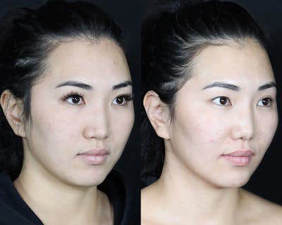 BOTOX Fillers Before & After Gallery - Patient 751375 - Image 1