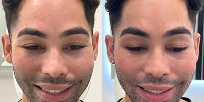 BOTOX Fillers Before & After Gallery - Patient 279366 - Image 1