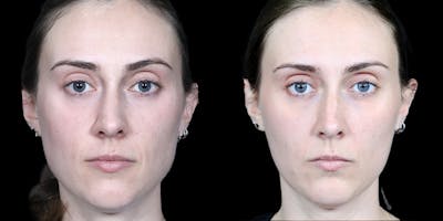 BOTOX Fillers Before & After Gallery - Patient 222832 - Image 1
