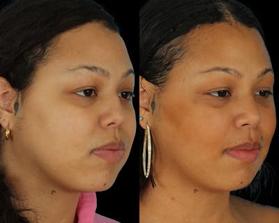 Buccal Fat Before & After Gallery - Patient 338577 - Image 1
