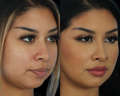 Buccal Fat Before & After Gallery - Patient 475698 - Image 1