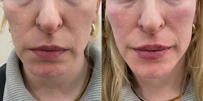 BOTOX Fillers Before & After Gallery - Patient 146779 - Image 1