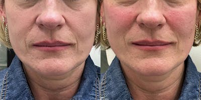 BOTOX Fillers Before & After Gallery - Patient 357865 - Image 1
