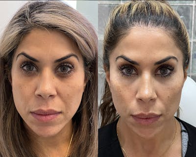 BOTOX Fillers Before & After Gallery - Patient 374857 - Image 1