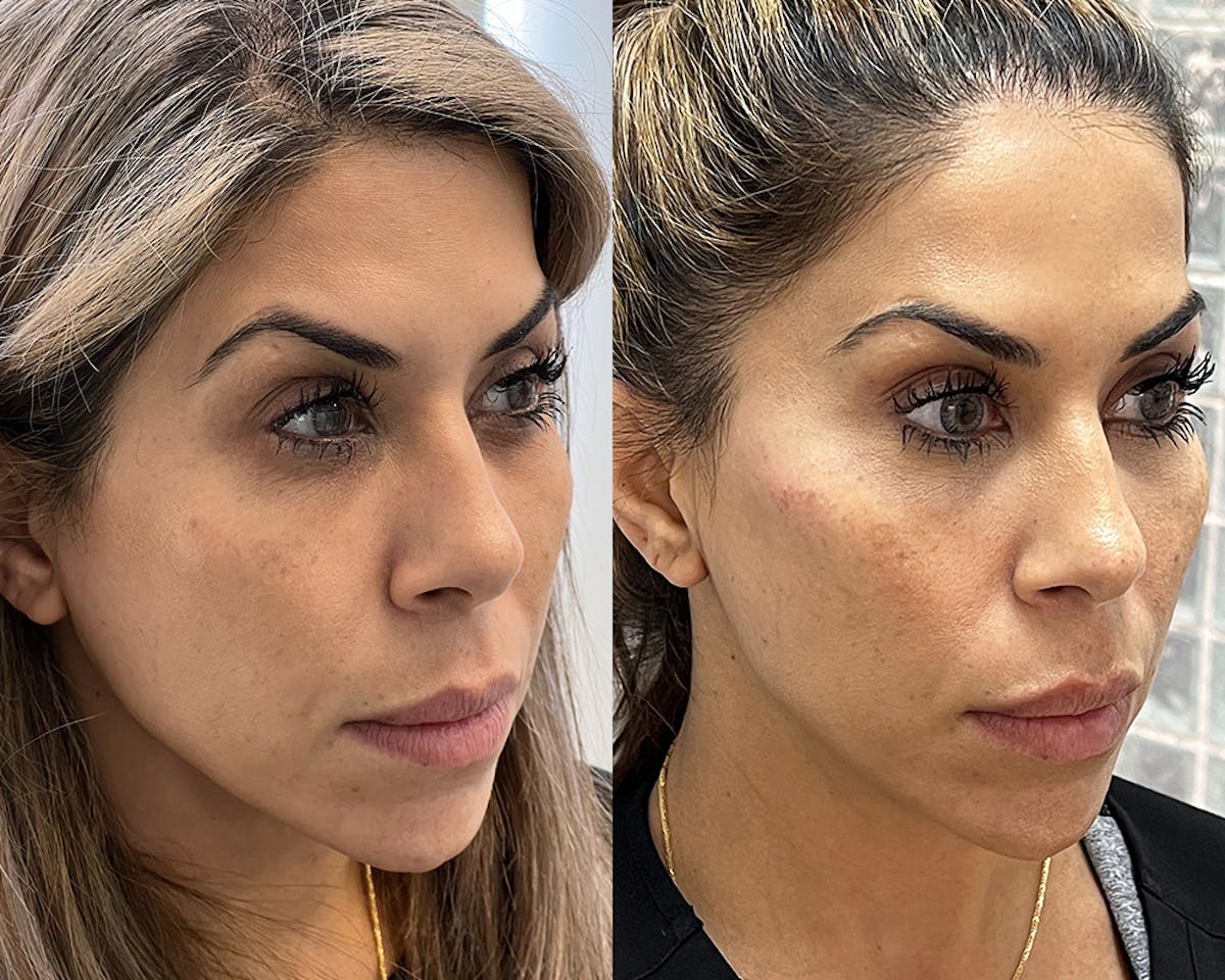 BOTOX Fillers Before & After Gallery - Patient 374857 - Image 2