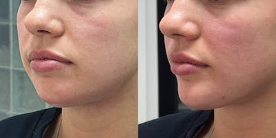 BOTOX Fillers Before & After Gallery - Patient 140099 - Image 1