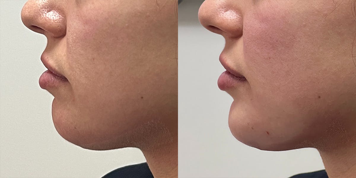 BOTOX Fillers Before & After Gallery - Patient 140099 - Image 2