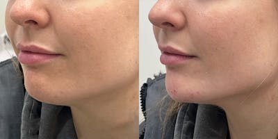 BOTOX Fillers Before & After Gallery - Patient 570821 - Image 1