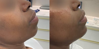 BOTOX Fillers Before & After Gallery - Patient 115151 - Image 1