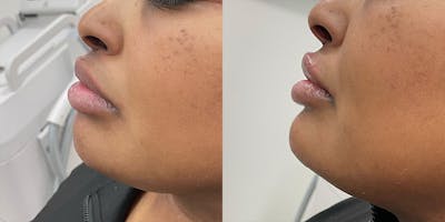 BOTOX Fillers Before & After Gallery - Patient 301352 - Image 1