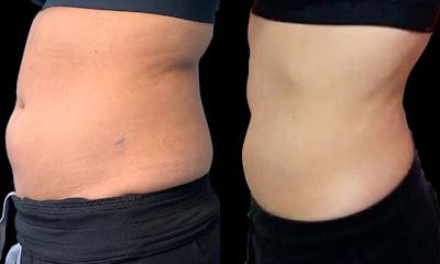 Coolsculpting Before & After Gallery - Patient 188448 - Image 1
